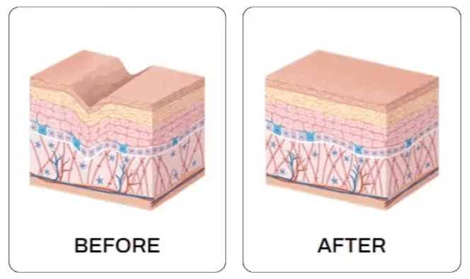 Skin Tissue Repair